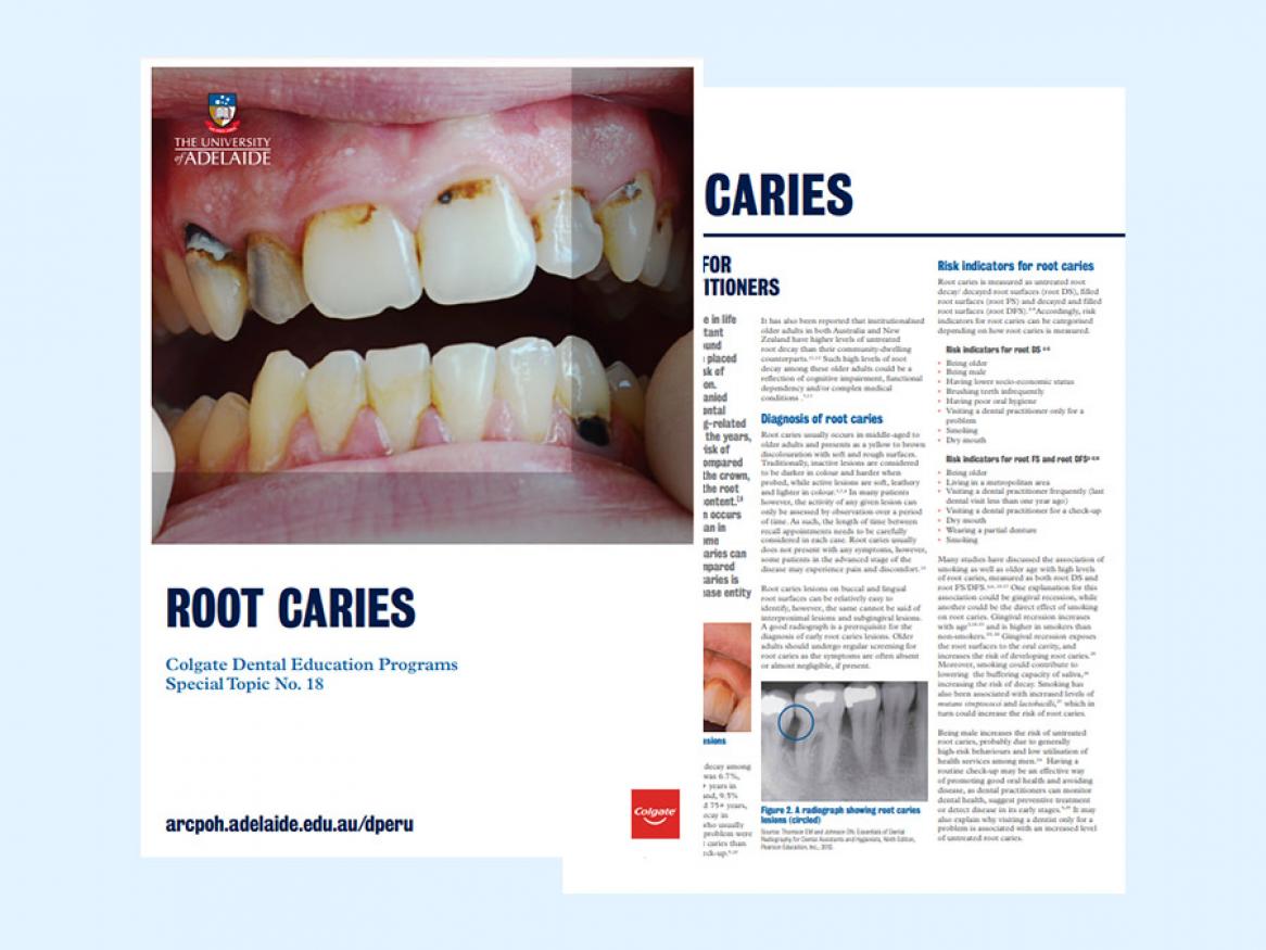 View the practice information sheet on root caries