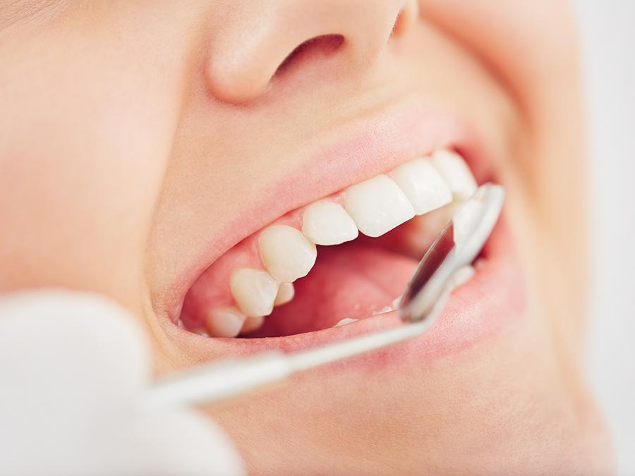 close up of smiliing mouth, teeth being checked by dentist